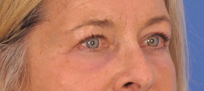 CO2RE Laser Before & After Gallery - Patient 140276 - Image 6