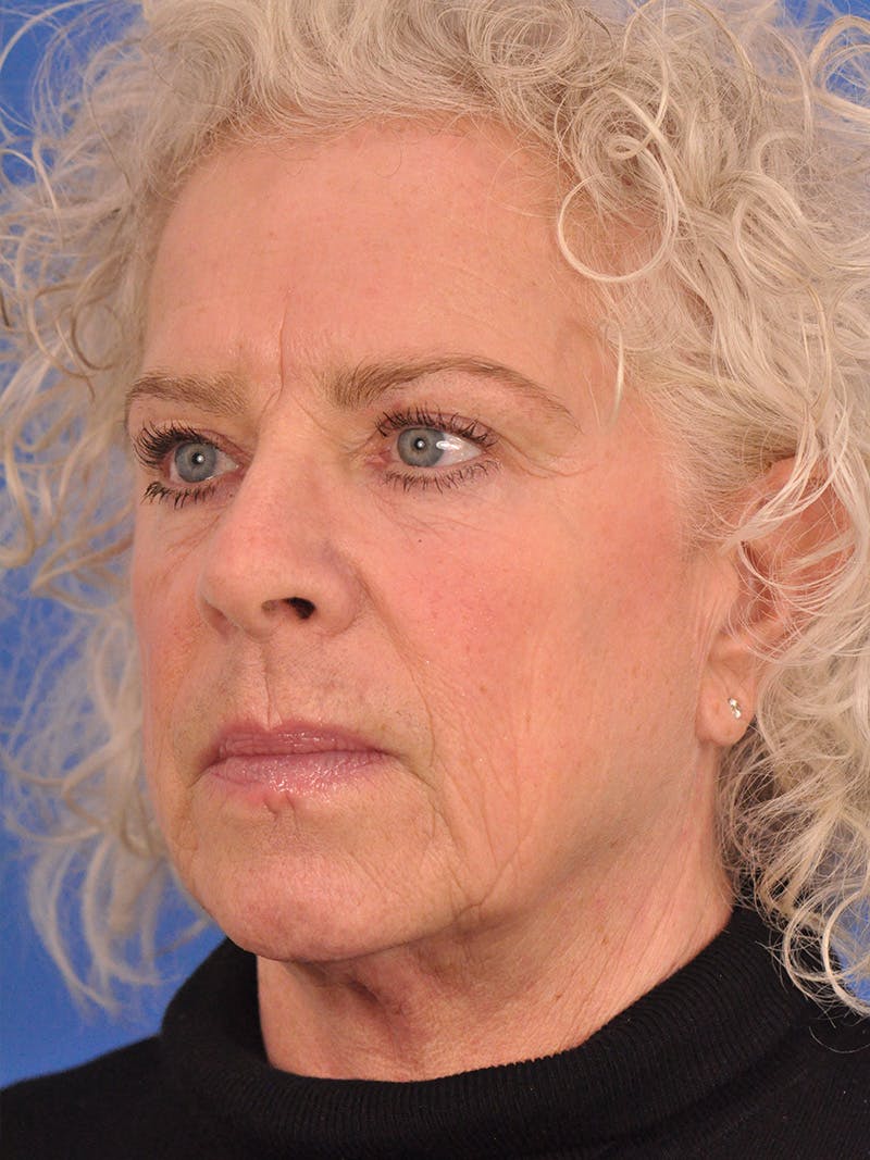 Neck Lift Before & After Gallery - Patient 563465 - Image 7