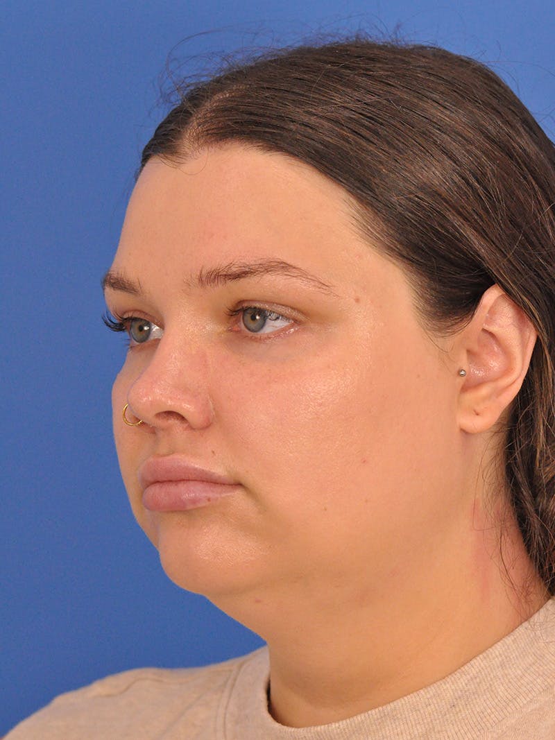 Chin Augmentation Before & After Gallery - Patient 174515 - Image 7