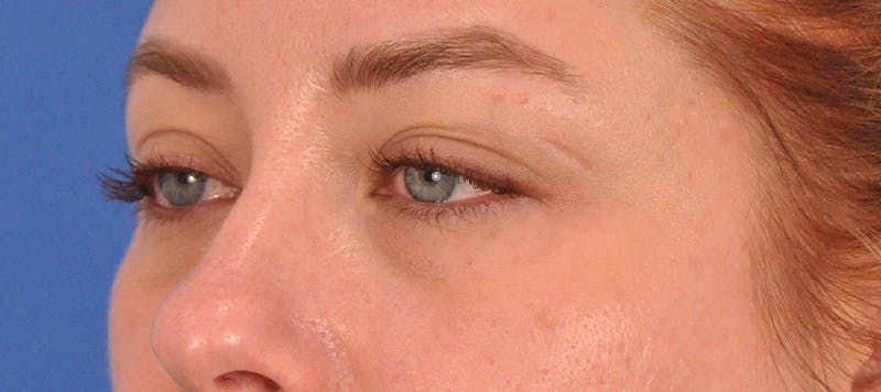 Blepharoplasty Before & After Gallery - Patient 391503 - Image 10