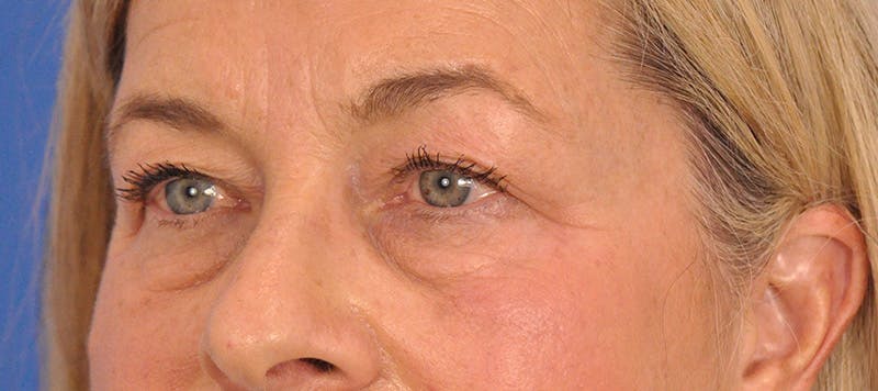 CO2RE Laser Before & After Gallery - Patient 140276 - Image 9