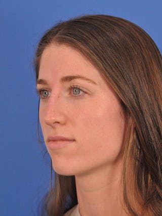 Liquid Rhinoplasty Before & After Gallery - Patient 395172 - Image 10