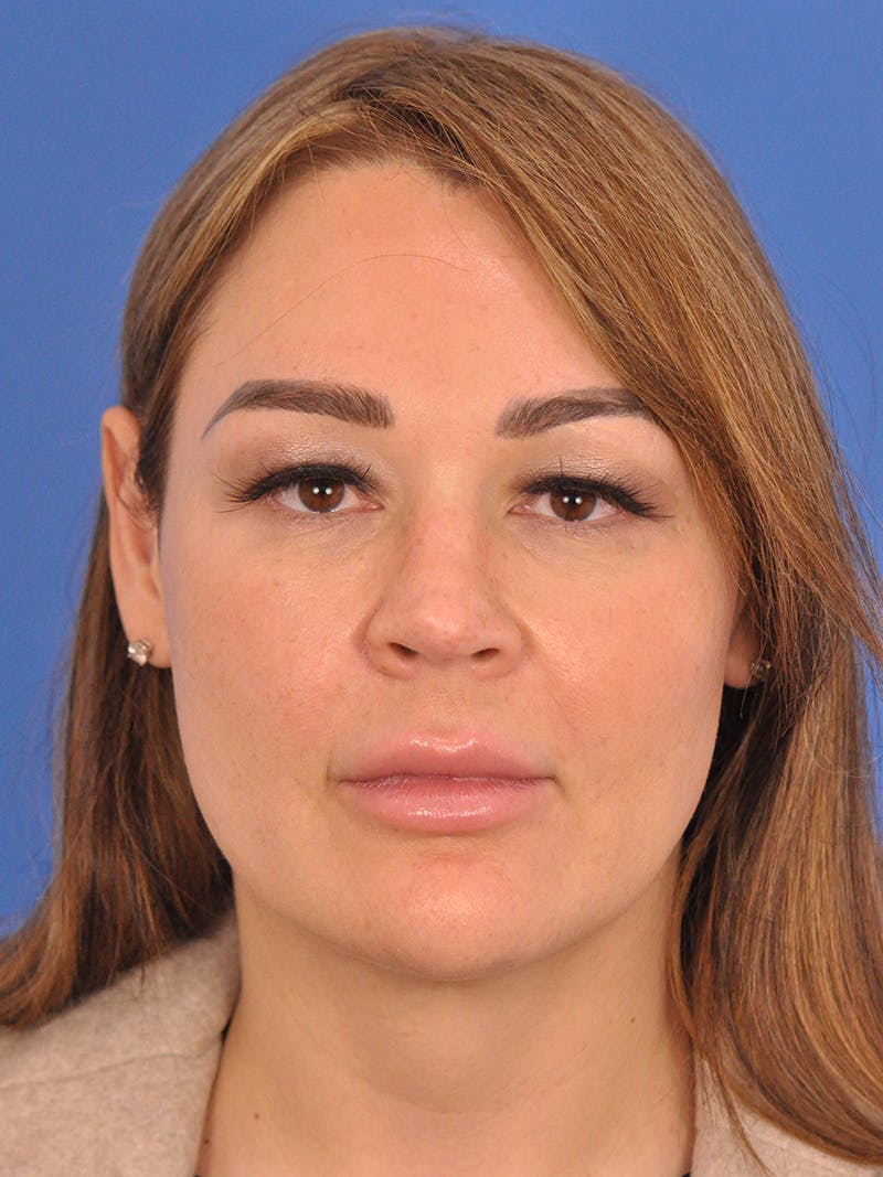 Rhinoplasty Before & After Gallery - Patient 386262 - Image 5