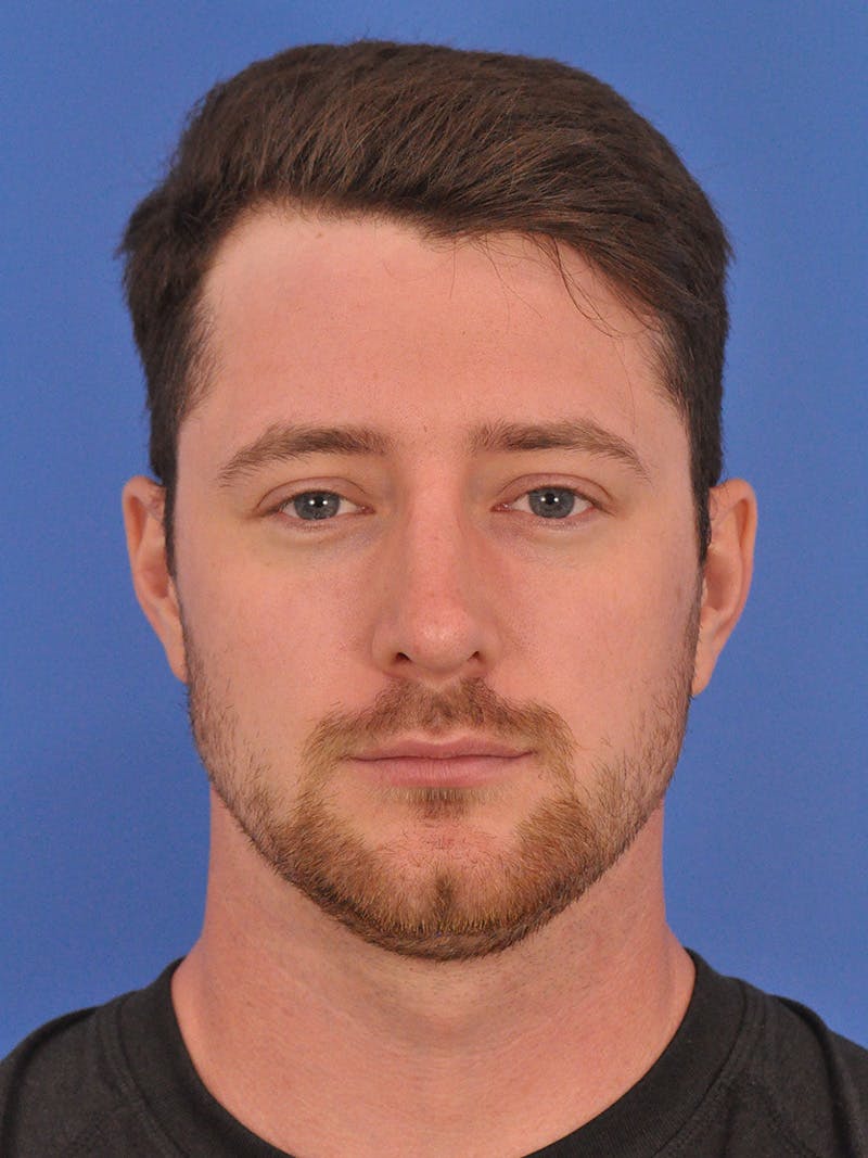 Chin Filler Before & After Gallery - Patient 228531 - Image 5