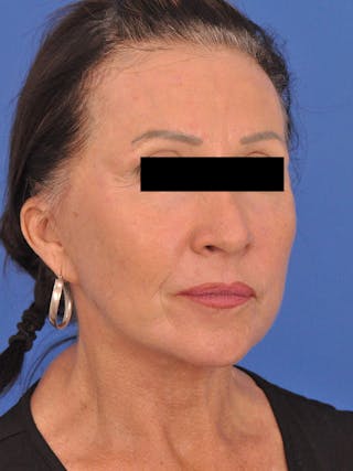 Neck Lift Before & After Gallery - Patient 128768 - Image 4