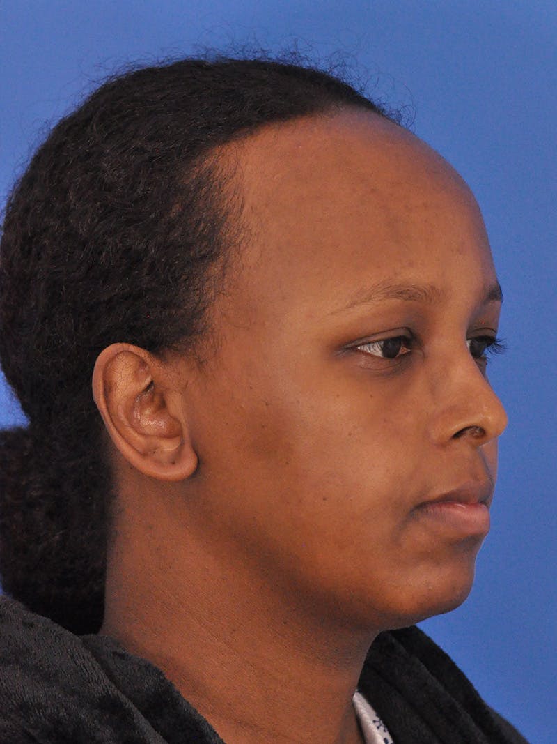 Forehead Reduction Before & After Gallery - Patient 196323 - Image 5