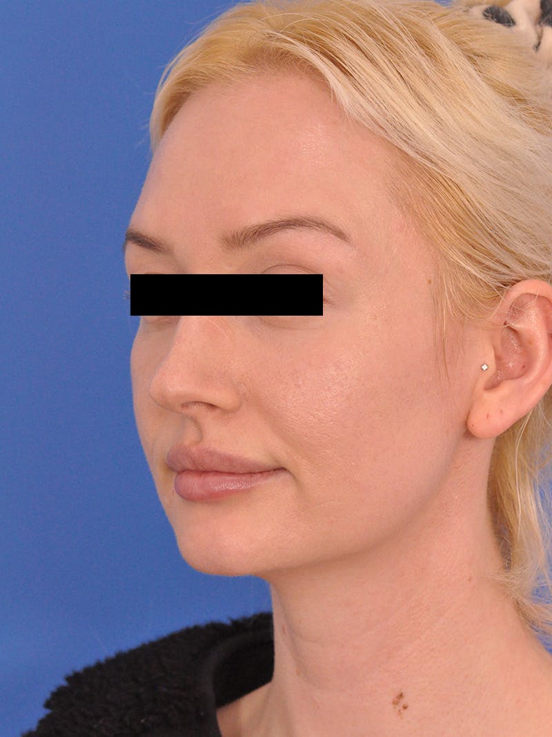 Rhinoplasty Before & After Gallery - Patient 368634 - Image 5