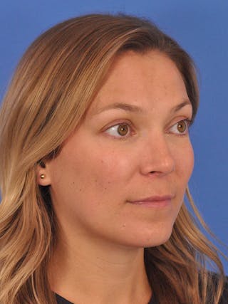 Cheek Filler Before & After Gallery - Patient 187973 - Image 6