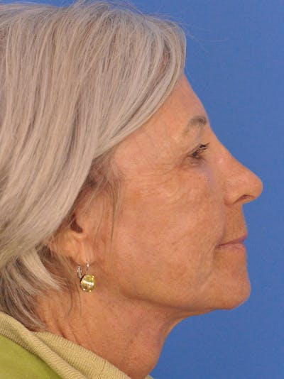 Neck Lift Before & After Gallery - Patient 181998 - Image 2