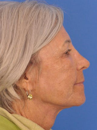 Blepharoplasty Before & After Gallery - Patient 341741 - Image 6