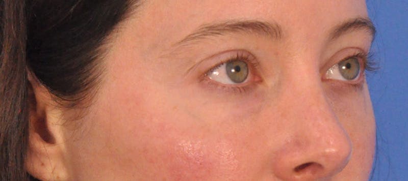 Tear Trough Filler Before & After Gallery - Patient 265185 - Image 6