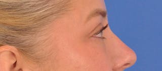 Blepharoplasty Before & After Gallery - Patient 391503 - Image 8