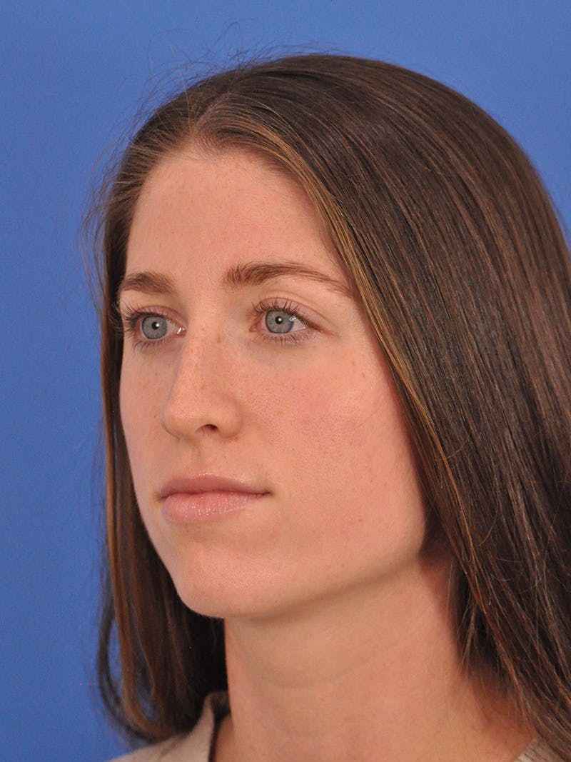 Liquid Rhinoplasty Before & After Gallery - Patient 395172 - Image 9