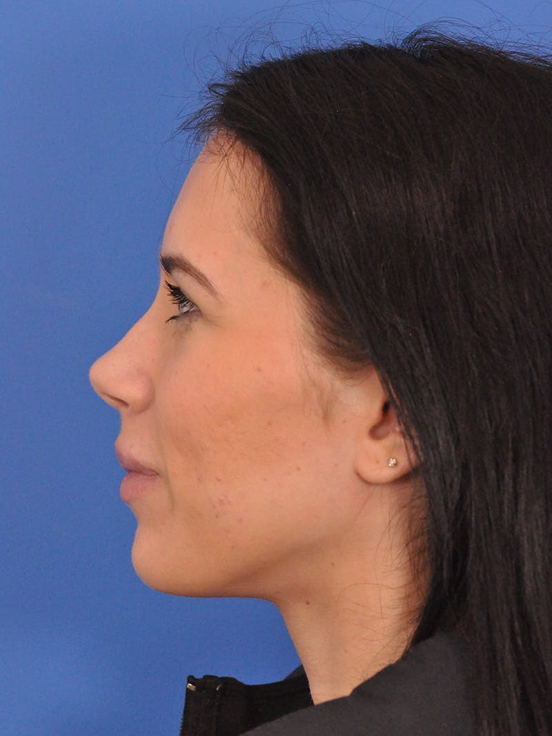 Rhinoplasty Before & After Gallery - Patient 405044 - Image 9