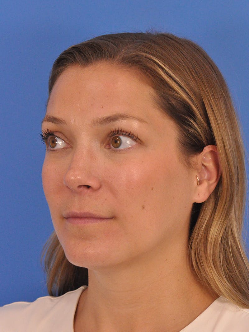 Cheek Filler Before & After Gallery - Patient 187973 - Image 11