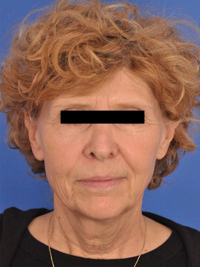 Facelift Before & After Gallery - Patient 161036 - Image 1