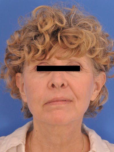 Facelift Before & After Gallery - Patient 161036 - Image 2