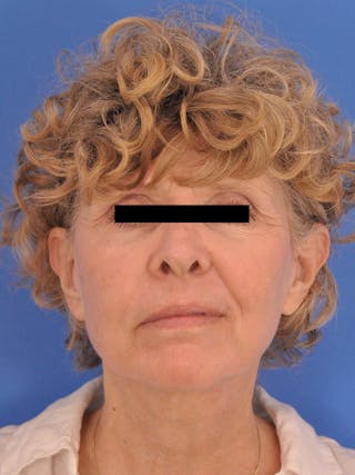 CO2RE Laser Before & After Gallery - Patient 372823 - Image 2