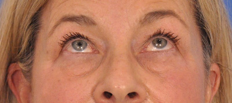 CO2RE Laser Before & After Gallery - Patient 140276 - Image 3