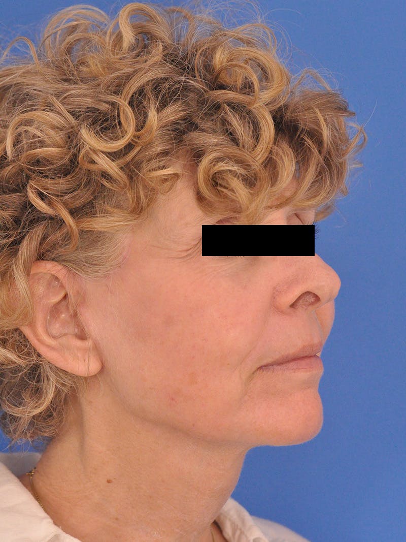Neck Lift Before & After Gallery - Patient 220229 - Image 4