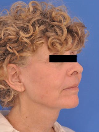 CO2RE Laser Before & After Gallery - Patient 372823 - Image 4