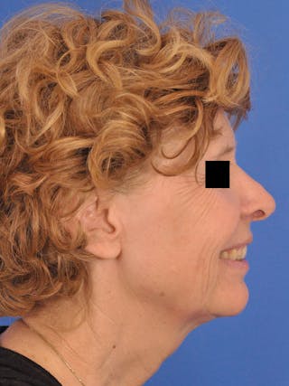 CO2RE Laser Before & After Gallery - Patient 372823 - Image 6
