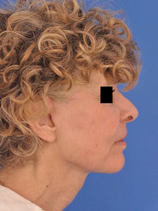 Neck Lift Before & After Gallery - Patient 220229 - Image 2