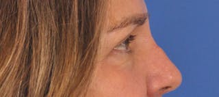 Blepharoplasty Before & After Gallery - Patient 761684 - Image 6