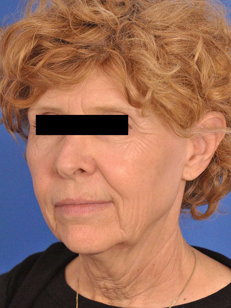 Neck Lift Before & After Gallery - Patient 220229 - Image 7