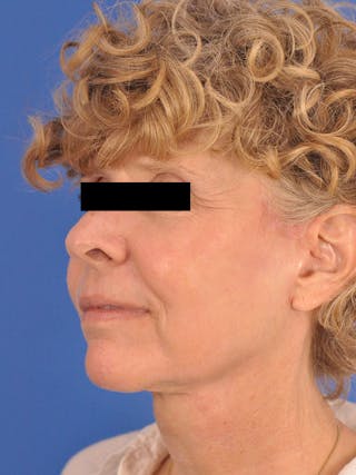 CO2RE Laser Before & After Gallery - Patient 372823 - Image 8