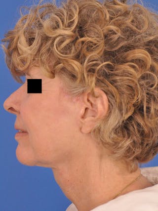 CO2RE Laser Before & After Gallery - Patient 372823 - Image 10