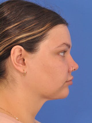 Chin Augmentation Before & After Gallery - Patient 174515 - Image 2