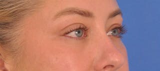 Blepharoplasty Before & After Gallery - Patient 391503 - Image 6