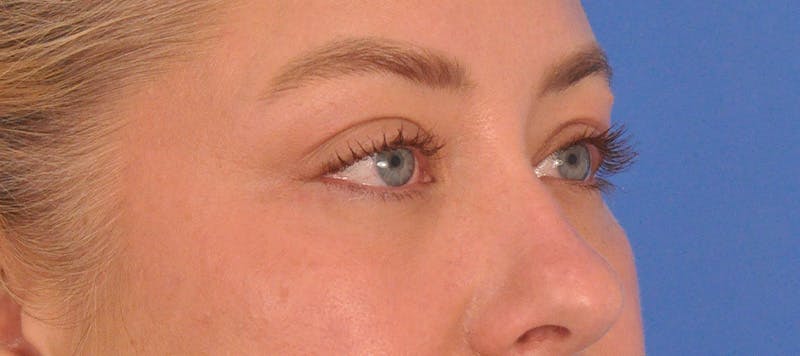 Blepharoplasty Before & After Gallery - Patient 391503 - Image 5