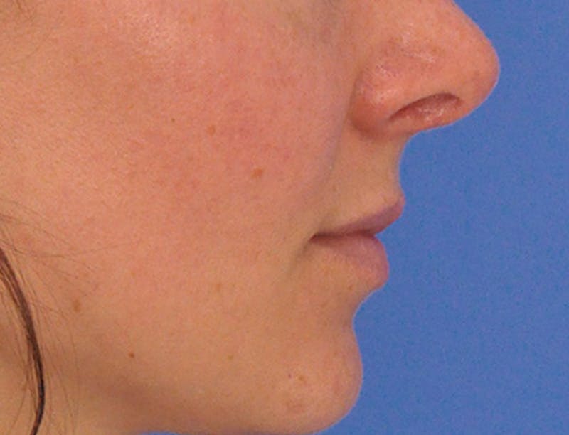 Lip Filler Before & After Gallery - Patient 829353 - Image 7