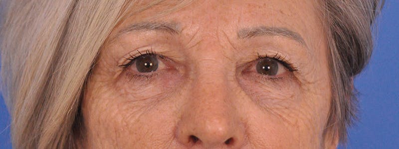 Blepharoplasty Before & After Gallery - Patient 341741 - Image 1