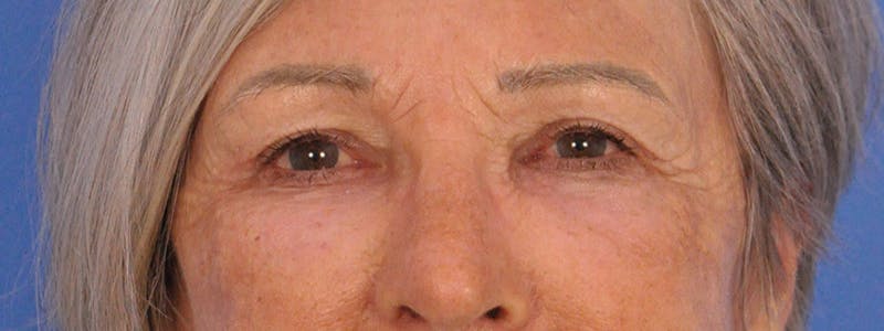 Blepharoplasty Before & After Gallery - Patient 341741 - Image 2