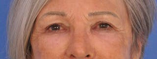 Blepharoplasty Before & After Gallery - Patient 341741 - Image 2