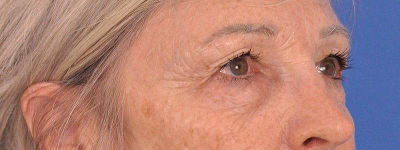 Blepharoplasty Before & After Gallery - Patient 341741 - Image 3