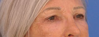 Blepharoplasty Before & After Gallery - Patient 341741 - Image 4