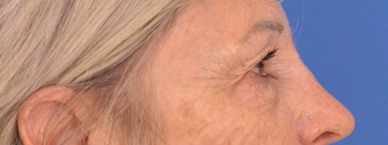 Blepharoplasty Before & After Gallery - Patient 341741 - Image 5