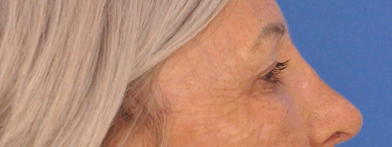 Blepharoplasty Before & After Gallery - Patient 341741 - Image 6