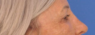 Blepharoplasty Before & After Gallery - Patient 341741 - Image 6