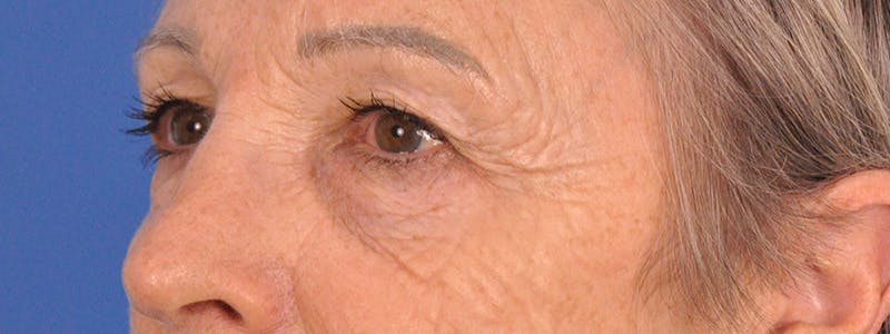 Blepharoplasty Before & After Gallery - Patient 341741 - Image 7