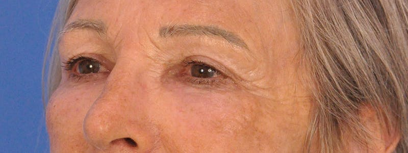 Blepharoplasty Before & After Gallery - Patient 341741 - Image 8