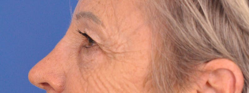Blepharoplasty Before & After Gallery - Patient 341741 - Image 9
