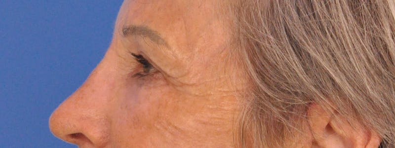 Blepharoplasty Before & After Gallery - Patient 341741 - Image 10