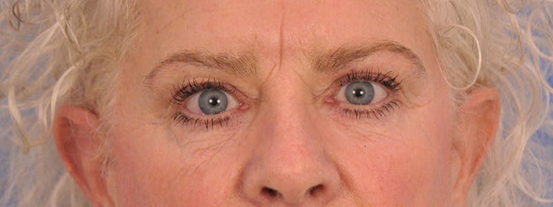 Blepharoplasty Before & After Gallery - Patient 893460 - Image 1