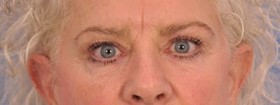 Blepharoplasty Before & After Gallery - Patient 893460 - Image 1