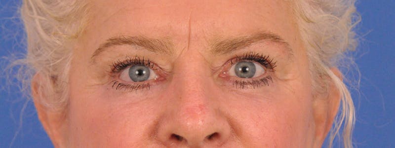 Blepharoplasty Before & After Gallery - Patient 893460 - Image 2